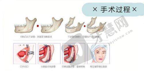 西安磨骨哪家医院好——西安某医院整形科