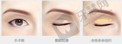 一针降颧骨是啥原理？是吸脂、注射萎缩剂还是填充改善呢？