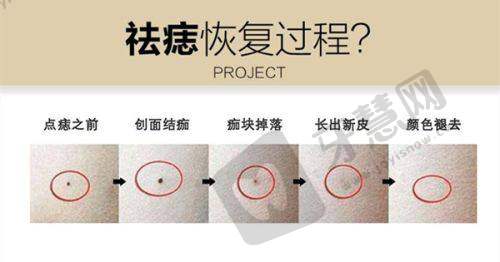 重庆白内障免费政策2025!农村户籍/低保户0元手术,附定点医院——预约排队攻略与注意事项