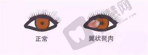 眼科手术科普信息