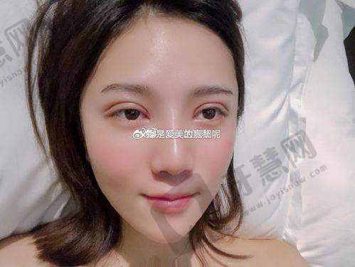 白永辉医生擅长的眼部整形项目