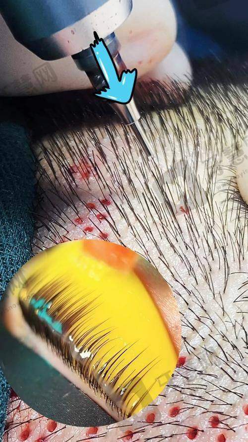 昆明青丝植发医院口碑好不好?附真实患者口碑评价