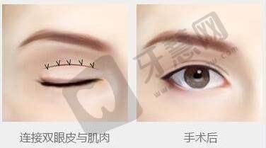 常见医美项目收费价格参考