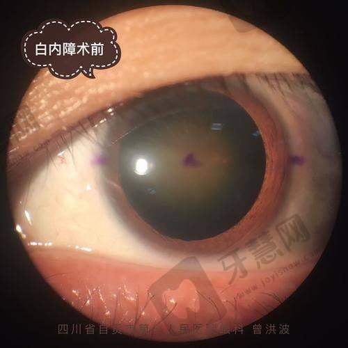 西安佰视佳眼科医院真人口碑评价怎么样？