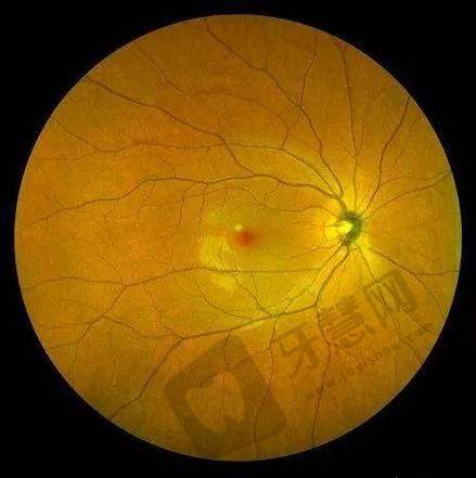 北京熙仁眼科医院透明的手术费用