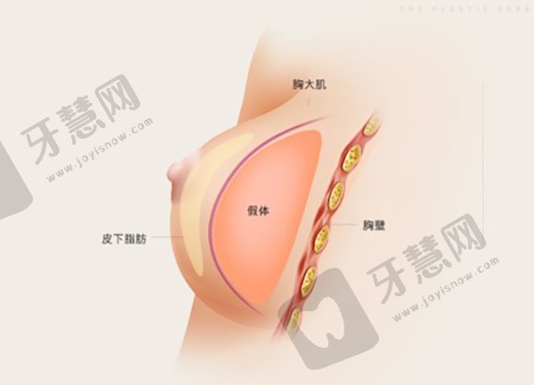 出彩医美十分钟隆胸真的假的,多少钱一次?揭秘出彩集团极速丰胸价格及成都出彩医美丰胸效果!