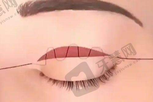 srt100浅放哪个医院有?河北与福建地区医院情况