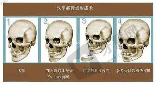 在线询问改善眼袋：术前术后注意事项，一篇说清！