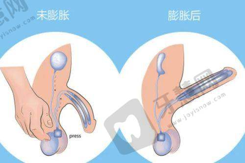 术后护理避坑指南：7天修复关键期