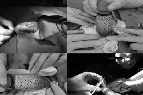 合肥做双眼皮重要医生之马路