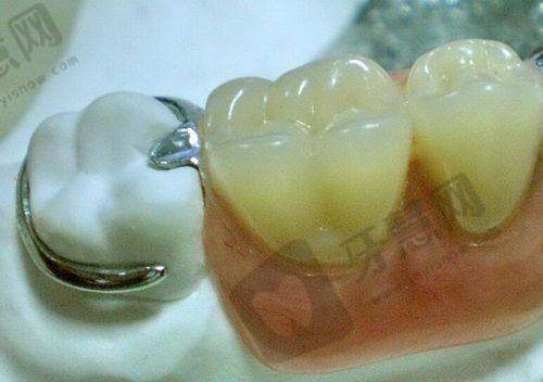 南京做烤瓷牙哪家好之单颗烤瓷牙种植相关医院