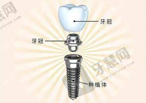 南京牙贴面多少钱一颗?美奥医院收费与技术优势