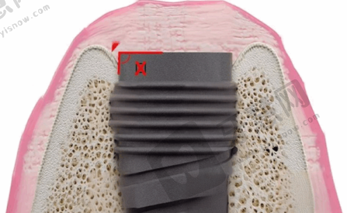 南京其他口腔医院牙齿美白价位与成效