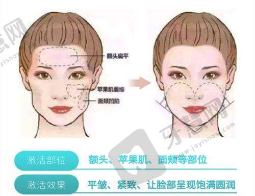 法令纹活动优惠询问：术前术后必看避坑指南