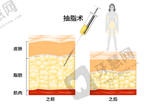 种植牙是一种什么样的体验？带你沉浸式了解种植牙全过程（文字版）——佛山高明医院种牙真人实例