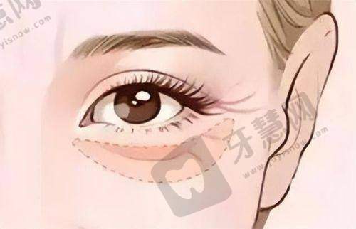 李自力做正颌技术腻害——精细的手术技术