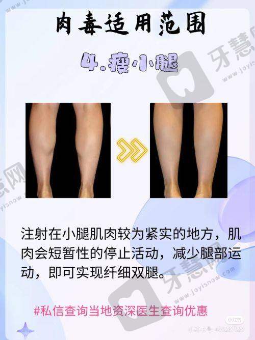 合肥双眼皮修复哪个医生专家做的好？孙洋/徐和林/甘泉涌技术优案例多