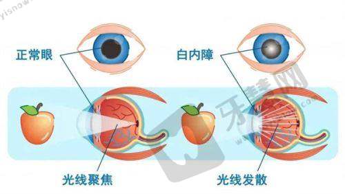 北京希玛琳顺潮眼科医院怎么样？亲测专家多价格亲民，全飞秒术后视力恢复好