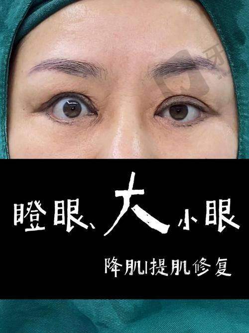 二、双眼皮修复联系方式：郑州贺洁医生坐诊医院及预约全攻略