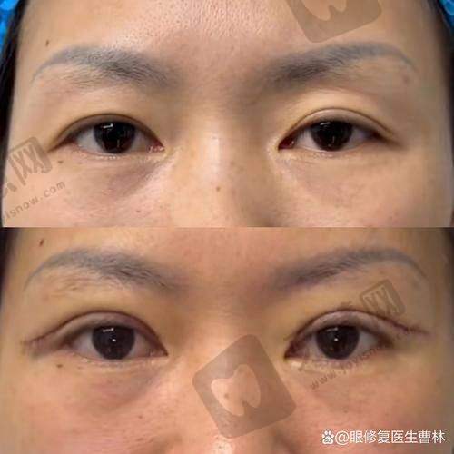 双眼皮修复面诊技巧之“揣着‘问题清单’去提问,别当‘听话木偶’”