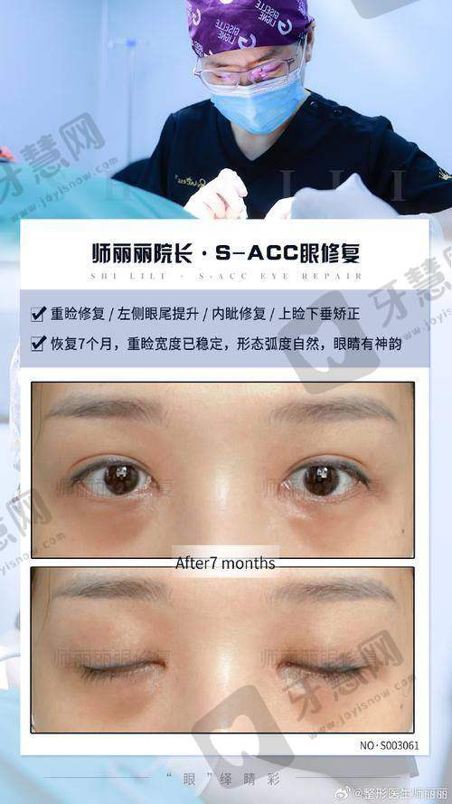 理性提醒：双眼皮修复去面诊应该在什么时候？“时机”和“医生”同样重要  