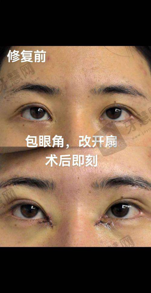 理性提醒：双眼皮修复，面诊是“试金石”