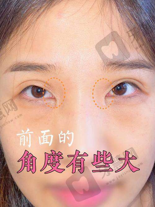 2025年眼袋祛除咨询：6800元起不开刀祛眼袋靠谱吗？3天见效医生名单大公开