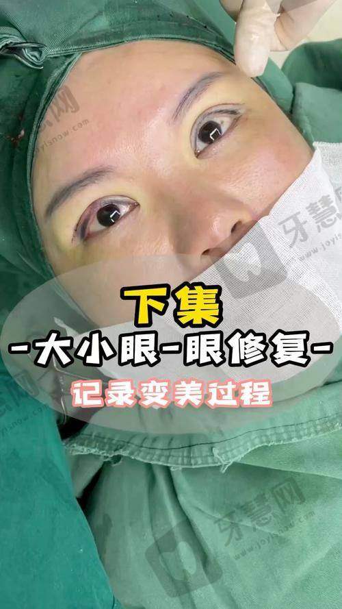 真实实例：花200元线上面诊后，她的“肉条眼”修复成这样…