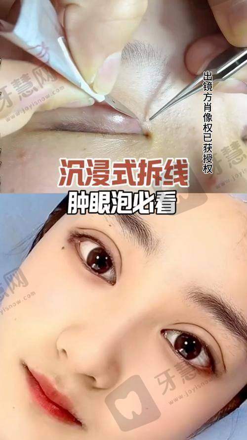 眼袋祛除询问：6800元起不开刀技术“真靠谱”还是“智商税”？