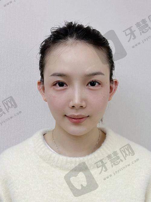 去打玻尿酸需要提前预约吗?真人实例告诉你预约的重要性