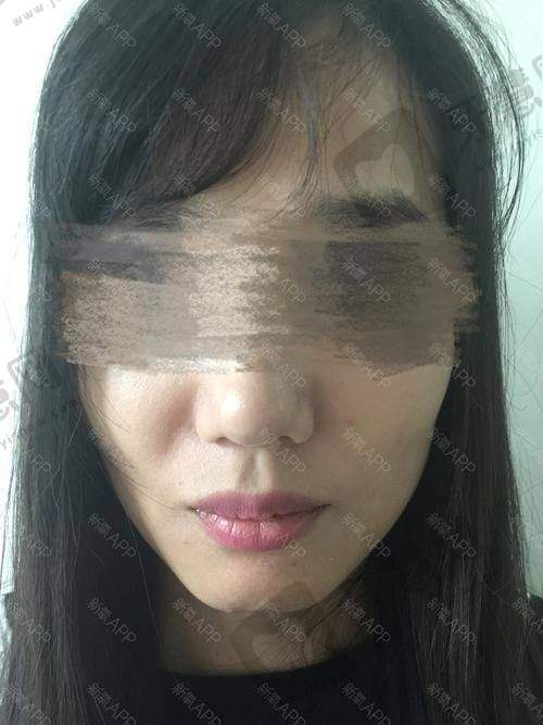 打玻尿酸询问哪些问题之维持时间？能管多久？补打周期怎么定？