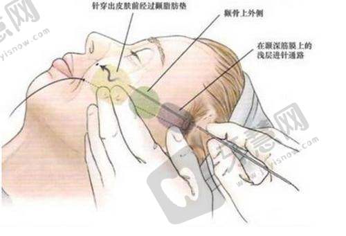 法令纹填充医美询问：玻尿酸/热玛吉/埋线提升，到底谁才是“法令纹杀手”？