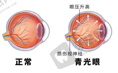 大连爱尔眼科医院近视手术详情