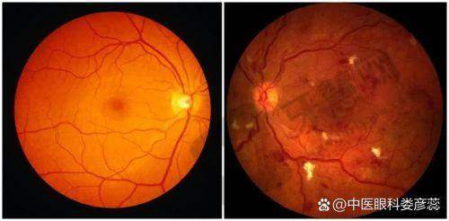 北京熙仁眼科医院马志中眼外伤诊疗技术