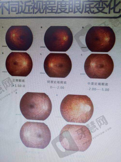 北京美尔目第二眼科医院的极高度近视眼矫正