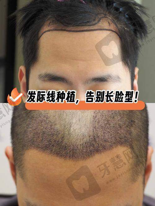 植发在线报名:为什么现在报名比线下更靠谱?3大优势实测
