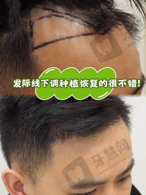 植发在线询问预约全流程避坑:从预约到手术,6个细节决定成败