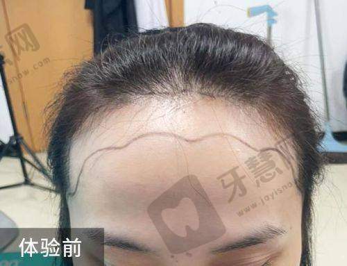 理性提醒:植发在线询问预约,永远把“正规”放第一