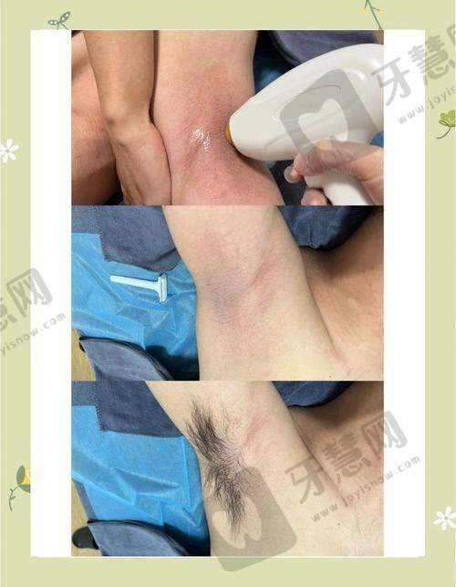 脱毛在哪个软件预约的终极建议?不同需求对应选择指南