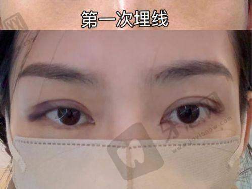 眼修复线上面诊200元能看到什么？拆解何文星医生的3步面诊流程