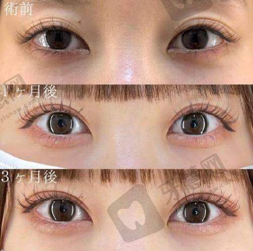 双眼皮修复去面诊应该在什么时候？5大黄金时间点+1v1面诊攻略必看！
