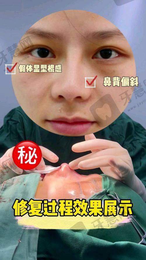 李泽松医生的技术优势：精细塑造自然鼻形