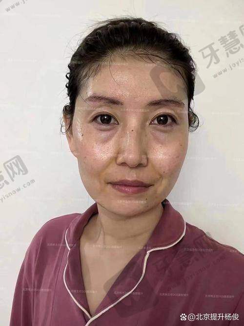 打肉毒素询问电话实例:从“踩坑”到“成功”的关键一步