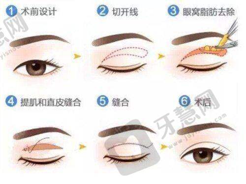 鼻子整形在线询问免费优势