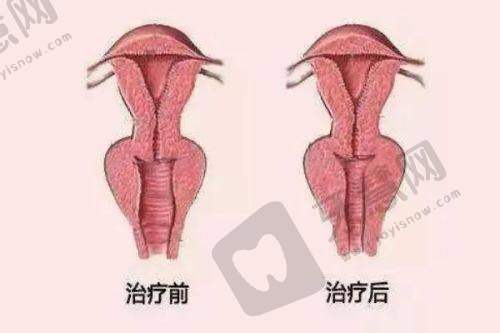 问题3:“治疗时痛吗?术后多久能正常生活?”——提前知道,不慌不忙