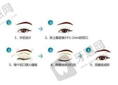 李宁医生做手术价格