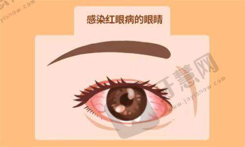 牵牛花综合征的症状表现