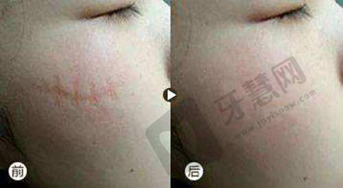 打Adm紧缩针维持多久之影响因素详解