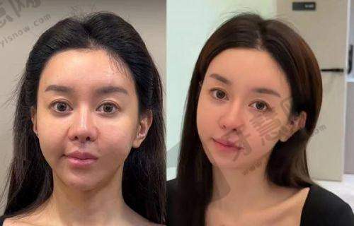 打Adm紧缩针维持多久之不同观点剖析