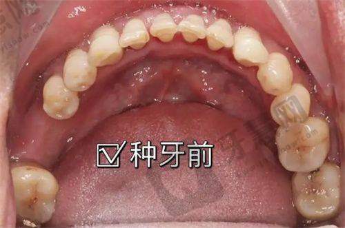 高玮茄做手术价格